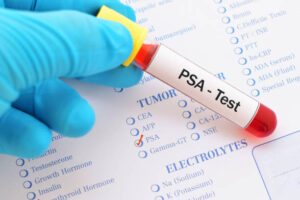 Read more about the article Prostate Specific Antigen Test Center in Naigaon